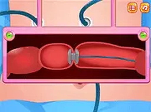 Colon Colectomy Surgery Online Game